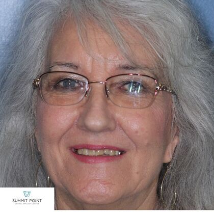 Dr. Sasan Khodabakhsh's patient before dentures